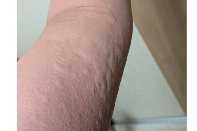 腕に苦しくて辛い蕁麻疹